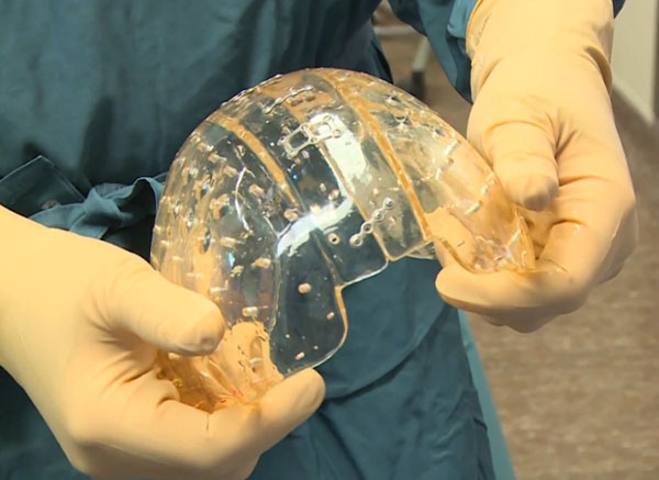 3d printed skull implant