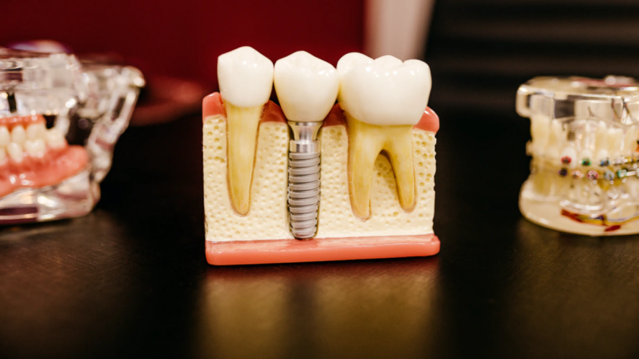 Restoring Smile On Face Whole Day Through 3d Printed Teeth
