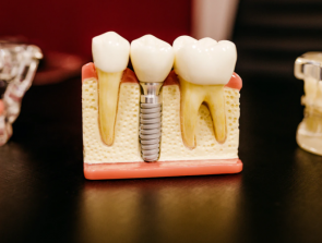 3D Printed Teeth: Revolutionizing Dentistry