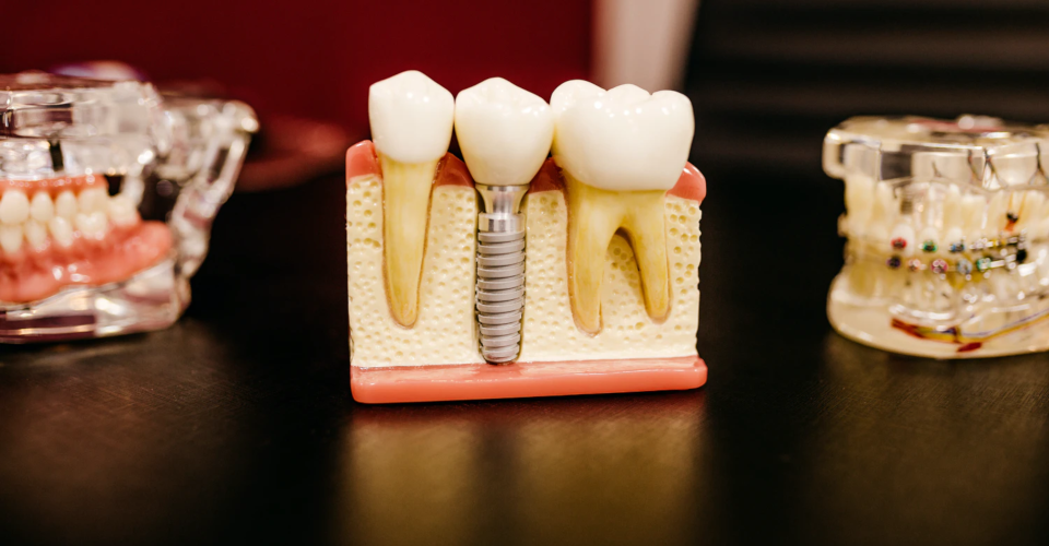 3D Printed Teeth: Revolutionizing Dentistry